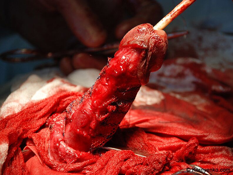 collagen matrix assembly for penis enlargement