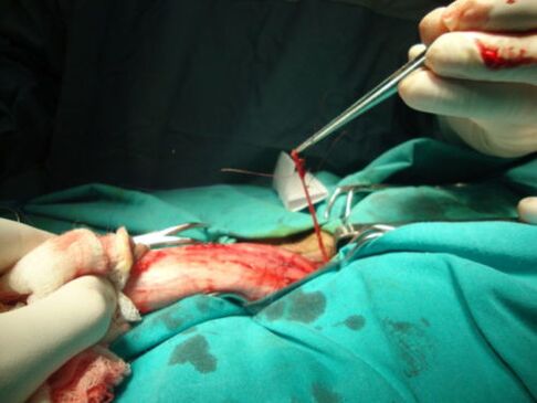 Enlargement of the penis